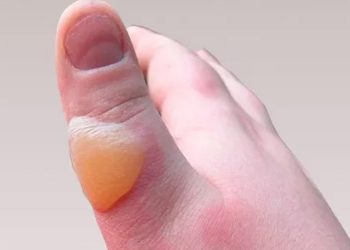 Yanıktan sonra su toplaması kaç günde geçer? Yanık su toplaması nasıl geçer?