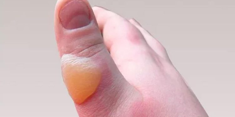 Yanıktan sonra su toplaması kaç günde geçer? Yanık su toplaması nasıl geçer?